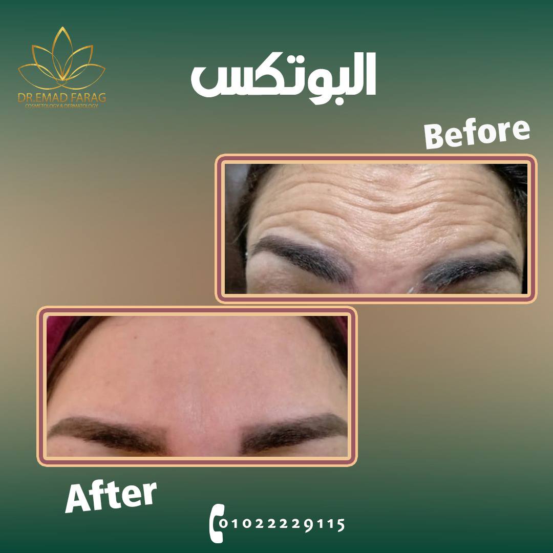 البوتكس Botox