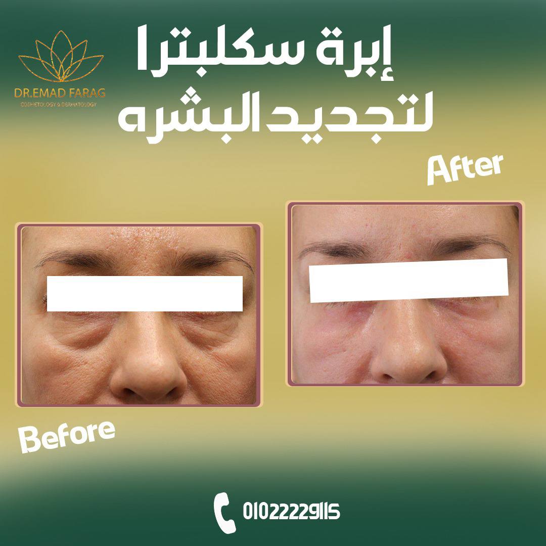 سكلبترا (Sculptra) لتجديد البشرة مع د. [عماد فرج]