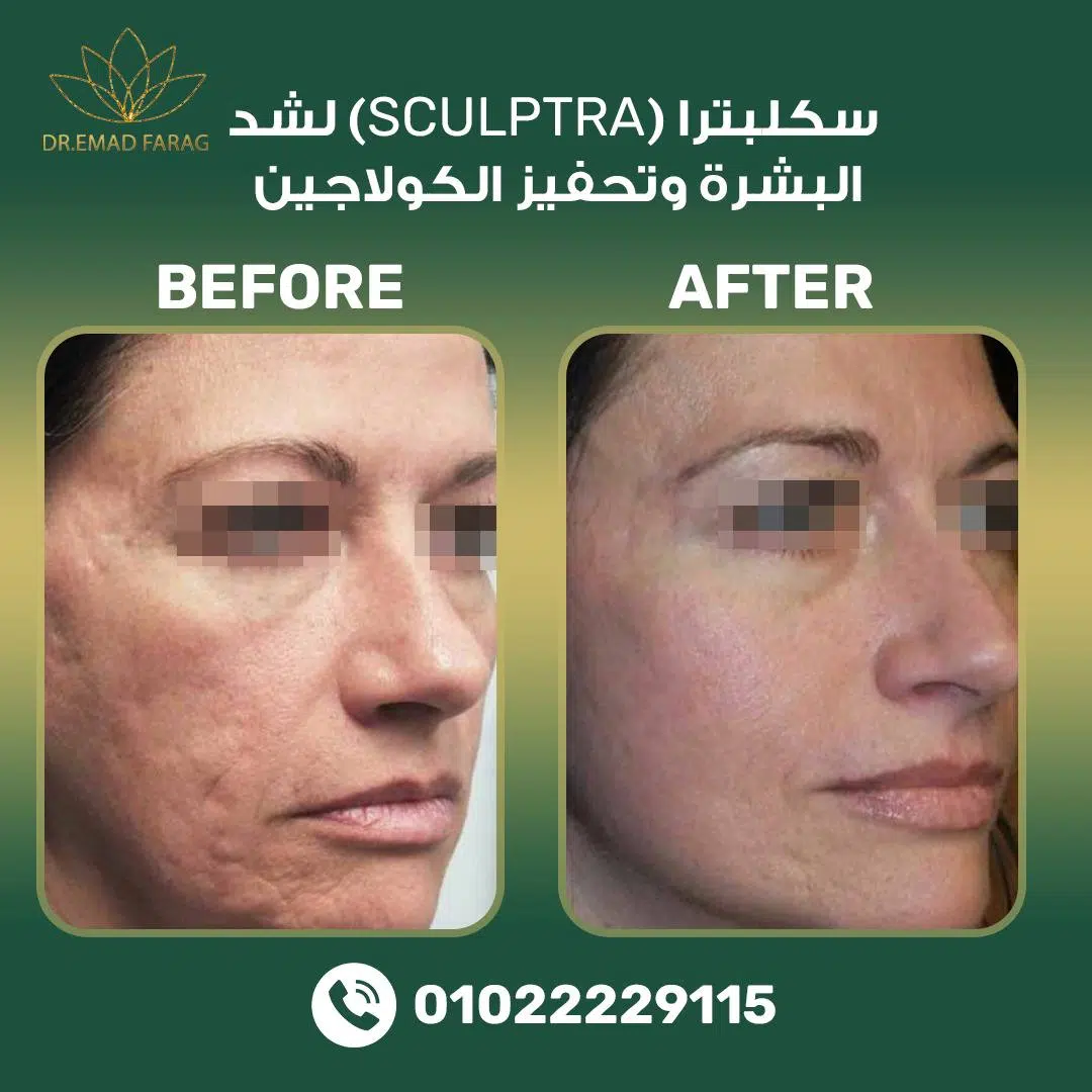 فوائد سكلبترا (Sculptra) لشد البشرة وتحفيز الكولاجين