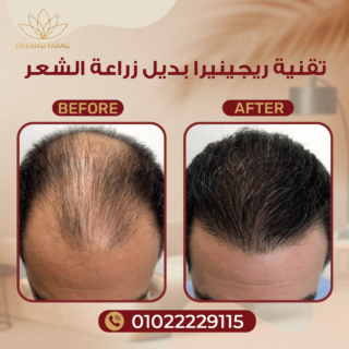 تقنية ريجينيرا بديل زراعة الشعر