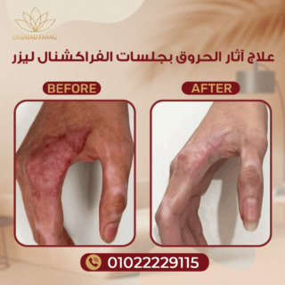 علاج آثار الحروق بجلسات الفراكشنال ليزر