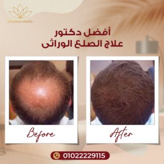 أفضل دكتور علاج الصلع