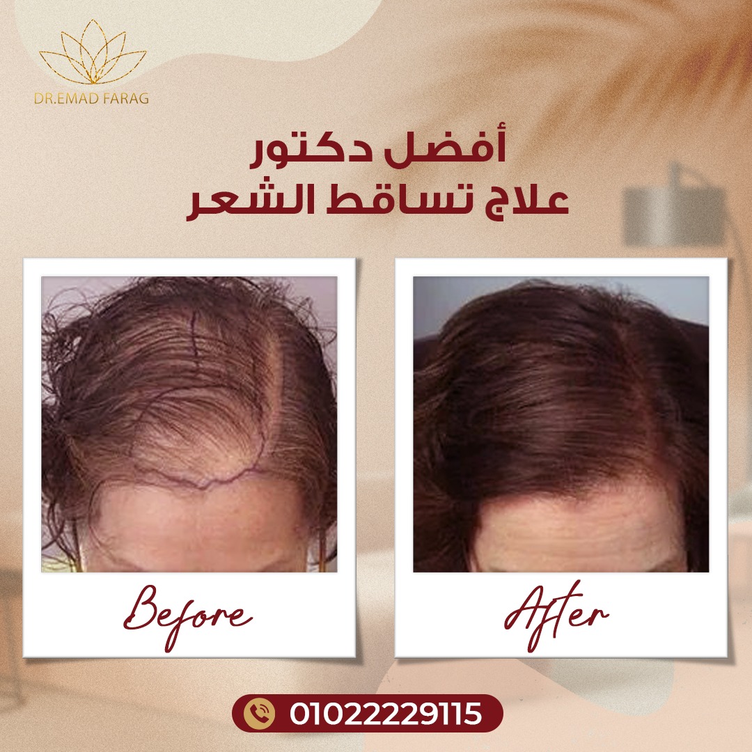 علاج تساقط الشعر