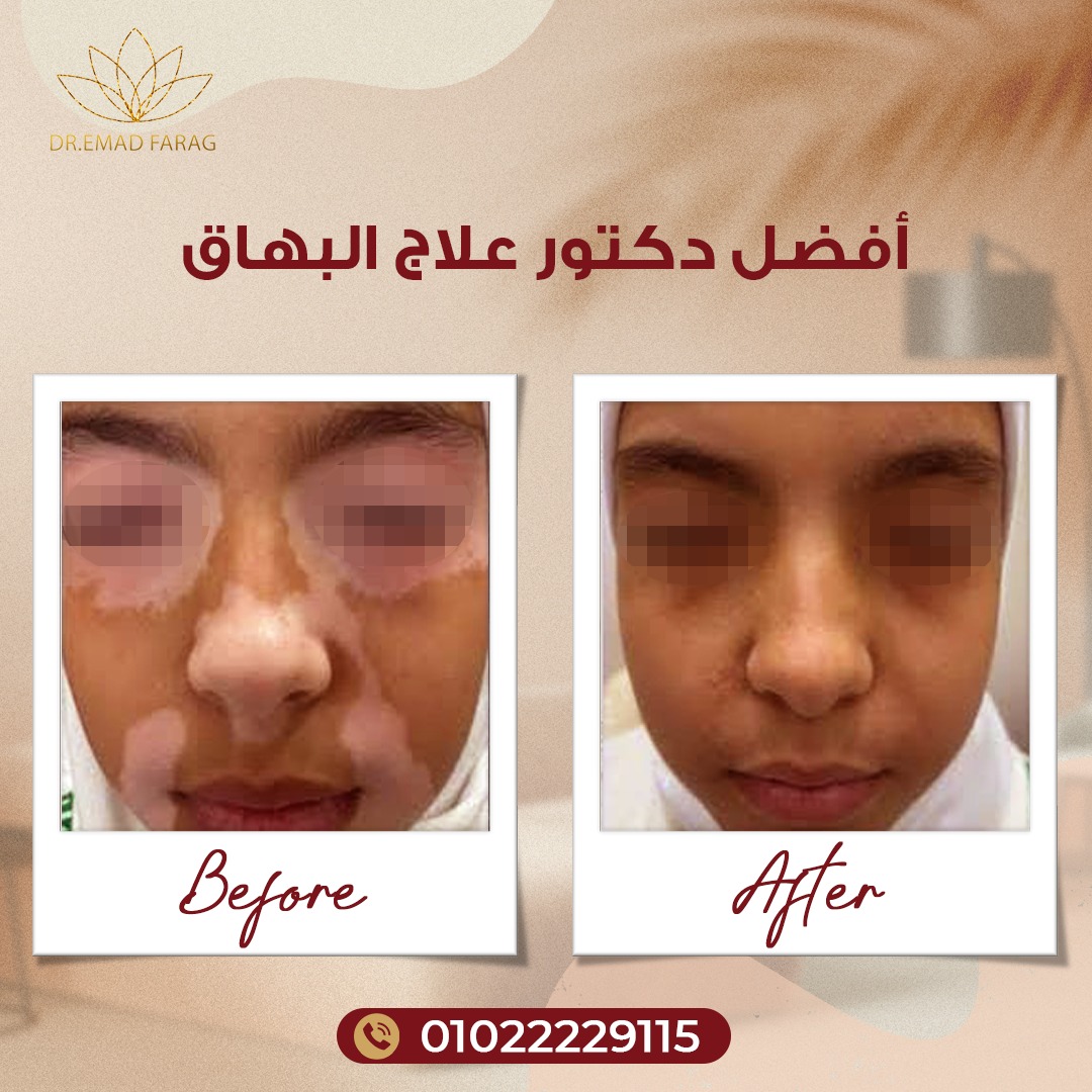 أفضل دكتور علاج البهاق - دكتور تجميل - دكتور عماد فرج