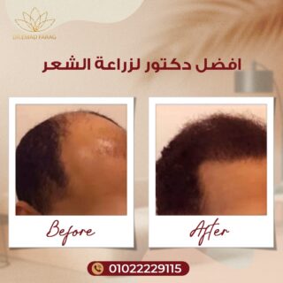 أفضل دكتور لزراعة الشعر