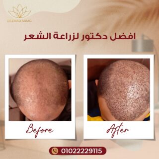 أفضل دكتور لزراعة الشعر
