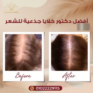 أفضل دكتور خلايا جذعية للشعر