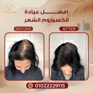 أفضل دكتور حقن اكسوزوم في مصر