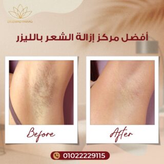 أفضل مركز إزالة الشعر بالليزر