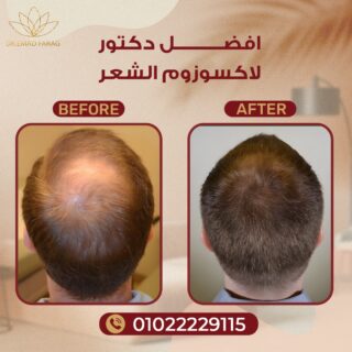 أفضل دكتور حقن اكسوزوم في مصر