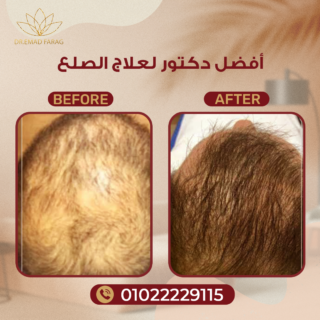 أفضل دكتور لعلاج الصلع